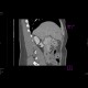 Portal cavernoma: CT - Computed tomography